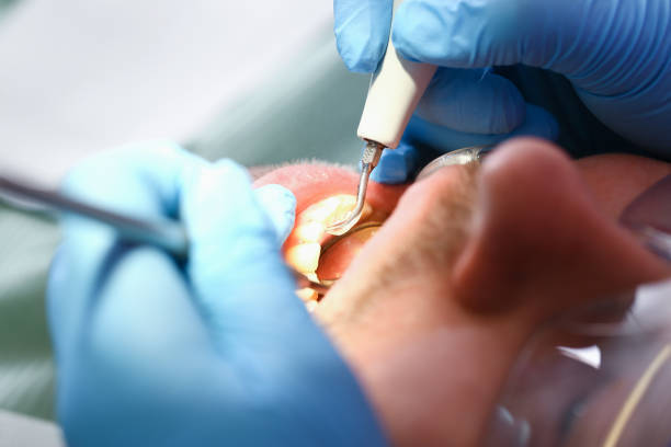 Best Knocked-Out Tooth (Avulsed Tooth) Treatment in Souderton, PA